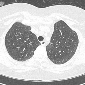 HRCT image in lung window