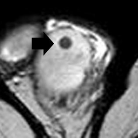 (a) Transverse (b) sagittal and (c) coronal T2 weighted images