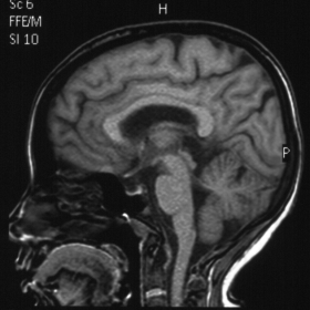 Sagittal T1-weighted image