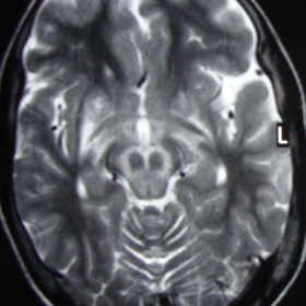 Axial T2- weighted MRI