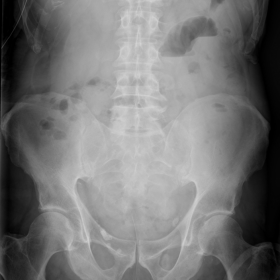Erect plain abdominal X-ray