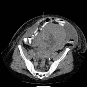 CT pelvis axial images