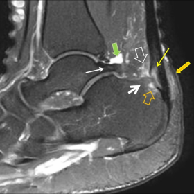 Sagittal fat-suppressed PD-w MR image