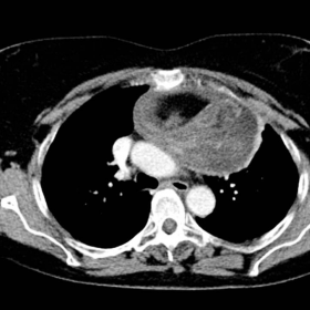 Chest CT, axial mediastinal image