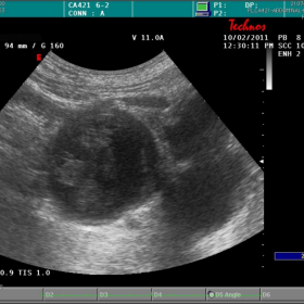 Ultrasound right iliac fossa