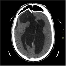 Unenhanced axial image through the level of the lateral ventricles