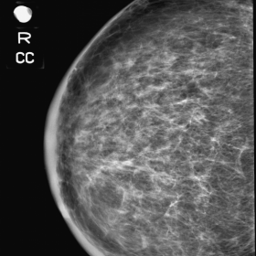 Mammogram craniocaudal view