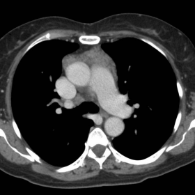 Axial chest CT