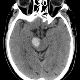 Initial brain CT (2 hours after symptoms onset)