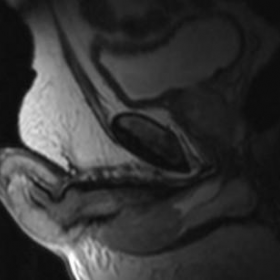 Initial MRI examination of the penis