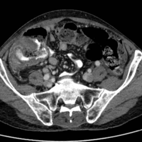 Axial contrast enhanced CT abdomen