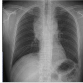 PA (a) and lateral (b) chest radiography