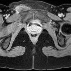 T1-weighted images after intravenous contrast administration