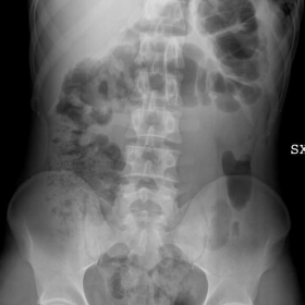 Initial plain abdominal radiographs