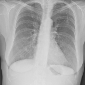 Preoperative chest X-ray