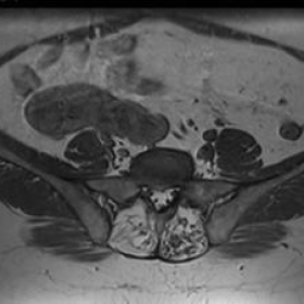 MRI - Pelvic anomaly