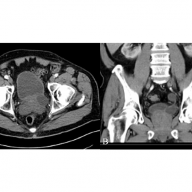 Portal phase contrast-enhanced pelvic CT