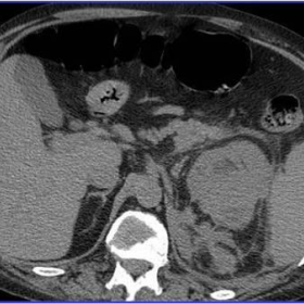 First CT examination - Baseline and venous-phase acquisition