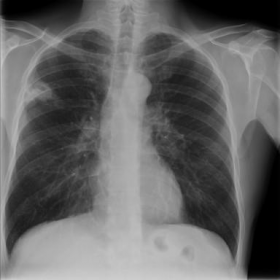 Initial chest radiographs at admission