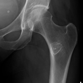 X-ray Left Hip