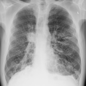PA chest radiograph at presentation