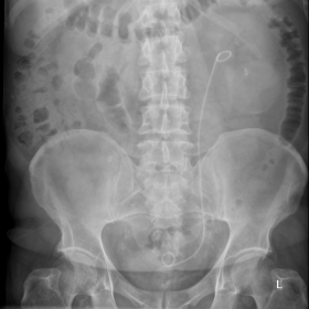 KUB X-RAY: Left JJ stent and left renal calculi.
