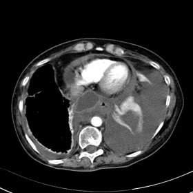 Contrast enhanced chest/abdominal CT