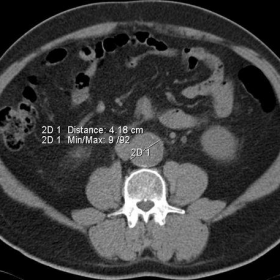 Noncontrasted abdominal CT