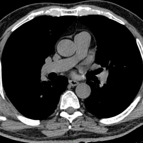 Unenhanced axial transverse CT images of the lower thorax