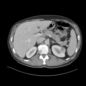 CT of the upper abdomen: Renal tumour
