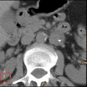 Axial CT view without CM