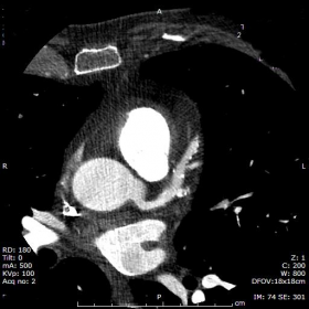 Coronary arteries ectasia: 2D images