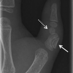 Frontal radiograph of the left thumb