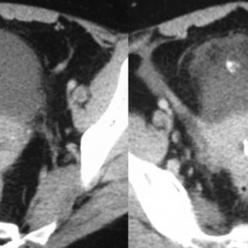Contrast enhanced pelvic CT
