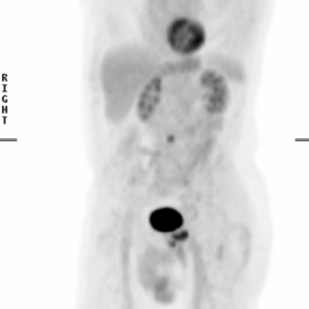 Attenuation corrected inverse grey scale FDG- PET/CT ‘half-body’ image