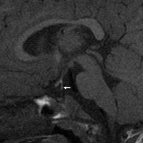 Sagittal T1 weighted MR