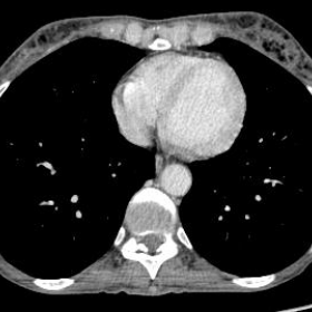 Axial CT at mammary region