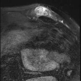 MRI imaging of the anterior chest wall