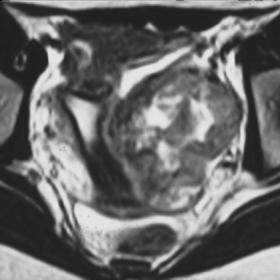 T2-weighted MR images show a left ovarian mass.