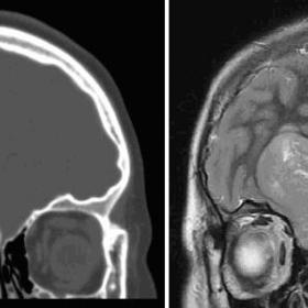 Coronal CT (left) and coronal T2W MRI (right)