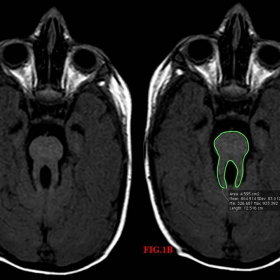 MRI T1WI brain