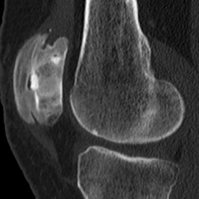 Sagittal CT image of the left knee.