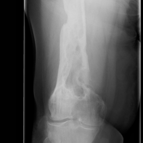 Plain radiograph of distal right femur