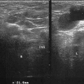 Bilateral Inguinal ultrasound