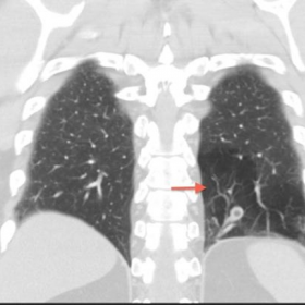 Coronal contrast-enhanced CT of the chest in Lung window