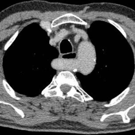 Axial contrast-enhanced CT of the thorax