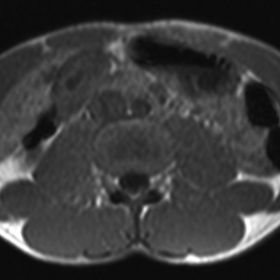 Axial T1 and T2-weighted MR