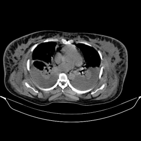 Axial non-enhanced CT of the abdomen