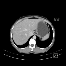 Contrast-enhanced CT Abdomen - Axial sections in venous phase
