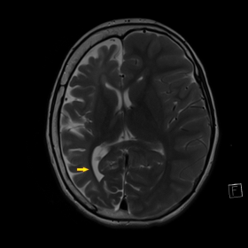 Non-contrast T2WI of the brain, axial plane